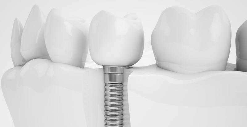 Affordable Dental Implants treatment in Camden high street