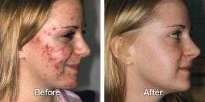 Avail the Best Acne Creams and Treatments in London