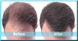 Best Hair Transplant Centre in India