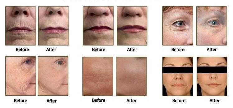 Better than Botox non surgical facelift using HIFU, 1 treatment lasts up to 3 years