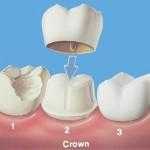 Cosmetic Crowns