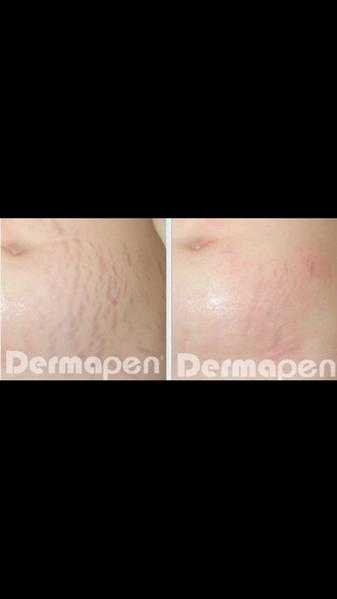 Dermapen advanced rejuvenation