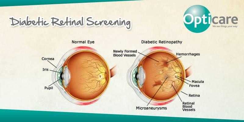 Diabetic Retinal Screening  For Your Family Need