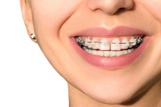 Experience Incredible Results with Orthodontics at Croydon