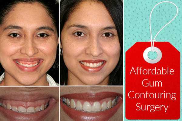 Experienced Cosmetic Dentist in Birmingham for Gum Contouring Surgery