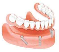 Get a Radiant Smile with All on 4 Dental Implant