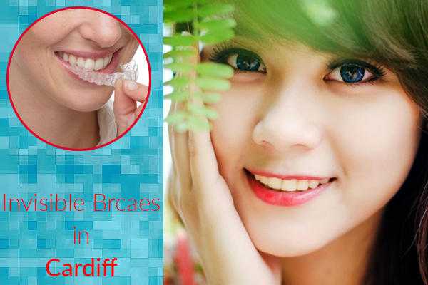 Get Affordable Invisible Braces Treatment by Expert Dentists from Cardiff in Cardiff