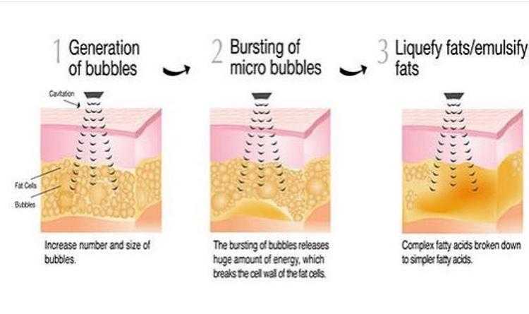 Guaranteed inch loss treatment. Pain free and non invasive cavitation. Lose upto 34 inches on day 1