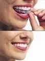 Keep Smiling with Damon Braces