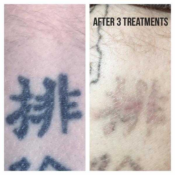 Laser Tattoo Removal