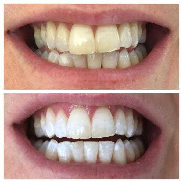 LASER TEETH WHITENING 100 FOR 2 PEOPLE