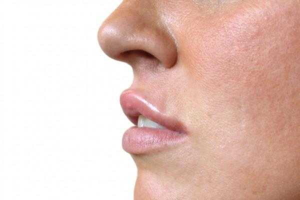 Lip and Facials Fillers in Essex Restylane amp Perlane Treatment in Essex