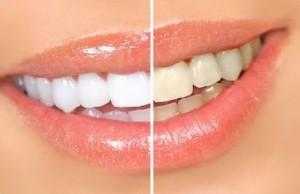 Make your teeth white