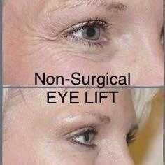 Non-Surgical Eye Lift Skin Tightening
