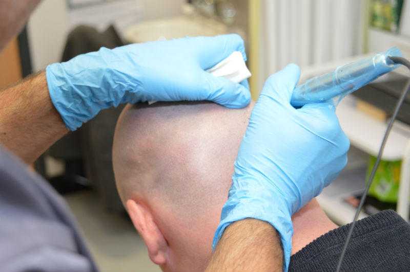 Non-Surgical Treatment for Hair Loss