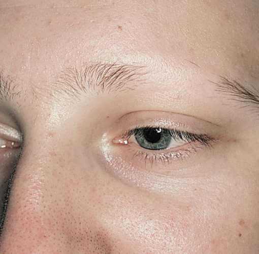 Rejuvenate - Eyebrow Transplant in London