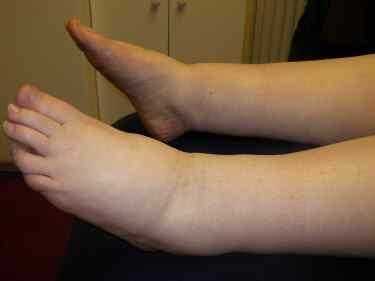 Relief for Painful, Swollen Legs using Manual Lymph Drainage.