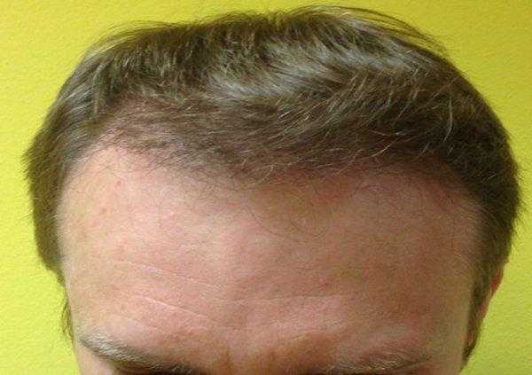 Save Money With Hair Transplant Surgery UK