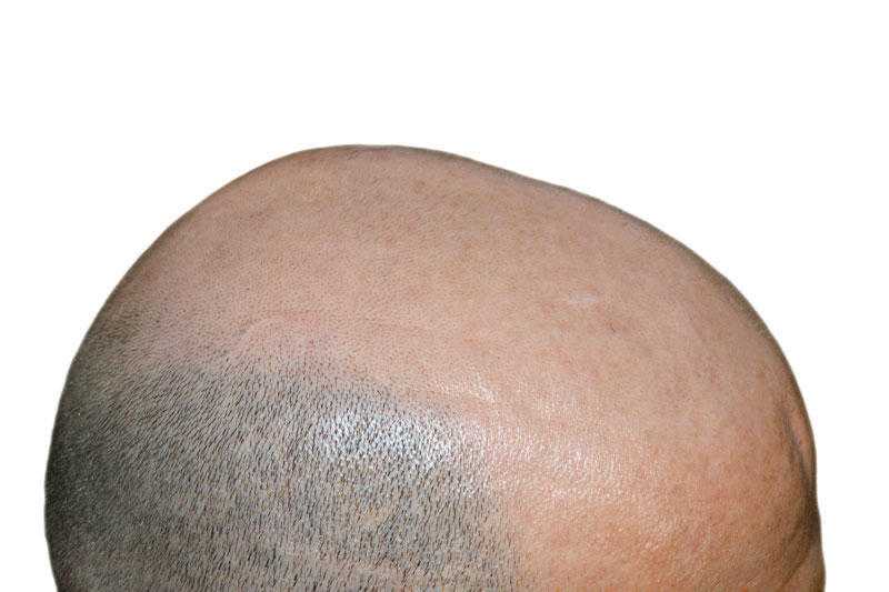 SCALP MICRO PIGMENTATION ESSEX BASED CLINIC OFFERS TREATMENT FOR  ALL TYPES OF HAIR LOSS