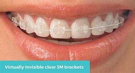 Teeth Straightening offer