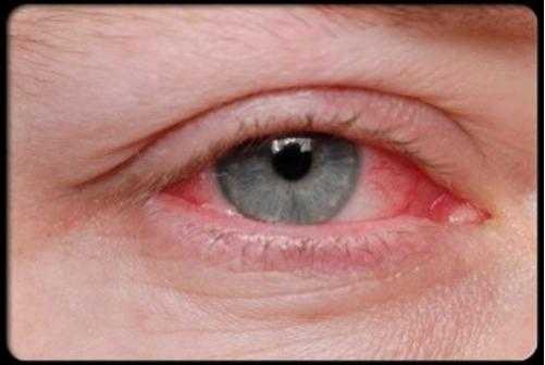 Treatment For Reduce Red Eye Symptoms