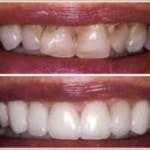 Veneers Treatment