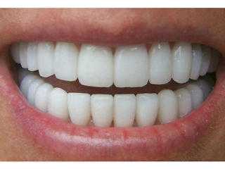 WEST YORKSHIRE MOBILE LASER TEETH WHITENING FROM 69 OR 2 PEOPLE FOR 120 - SPECIAL OFFER